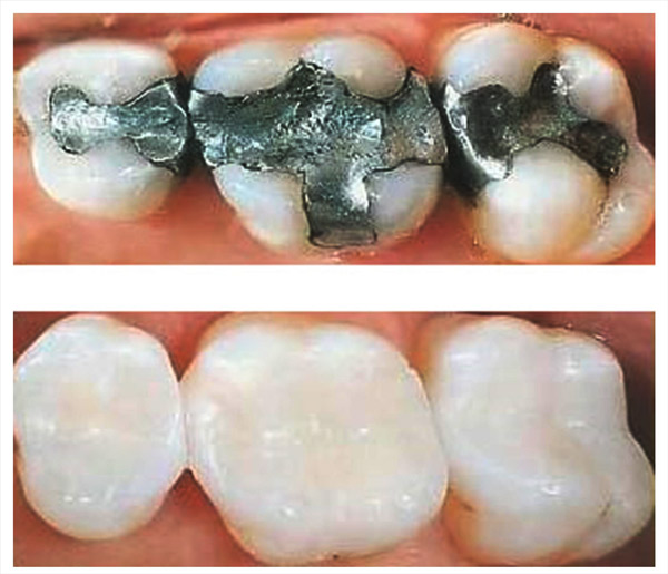 Αισθητικά σφραγίσματα και επένθετα – DoctorSmile