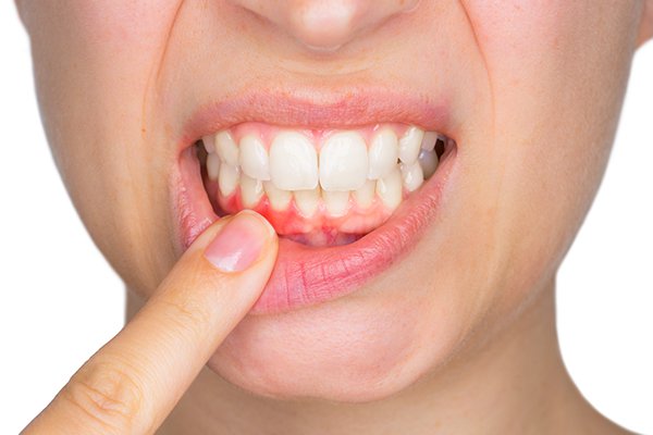 Περιοδοντίτιδα Gum inflammation