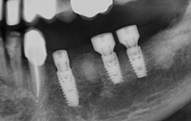 implants after 4 months