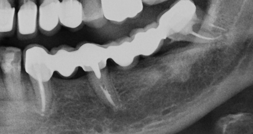 radiography before implants