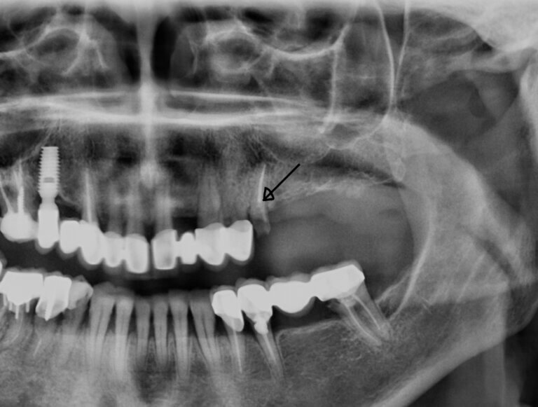 broke tooth