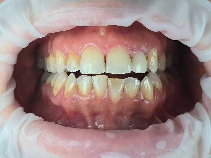 Φυσικά δόντια πρίν τις ολοκεραμικές στεφάνες