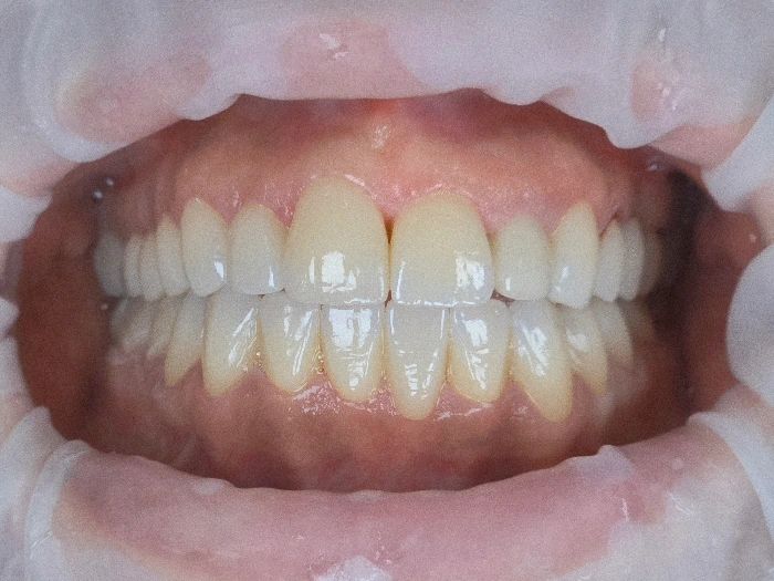 Αισθητική Οδοντιατρική Ολοκεραμικές στεφάνες