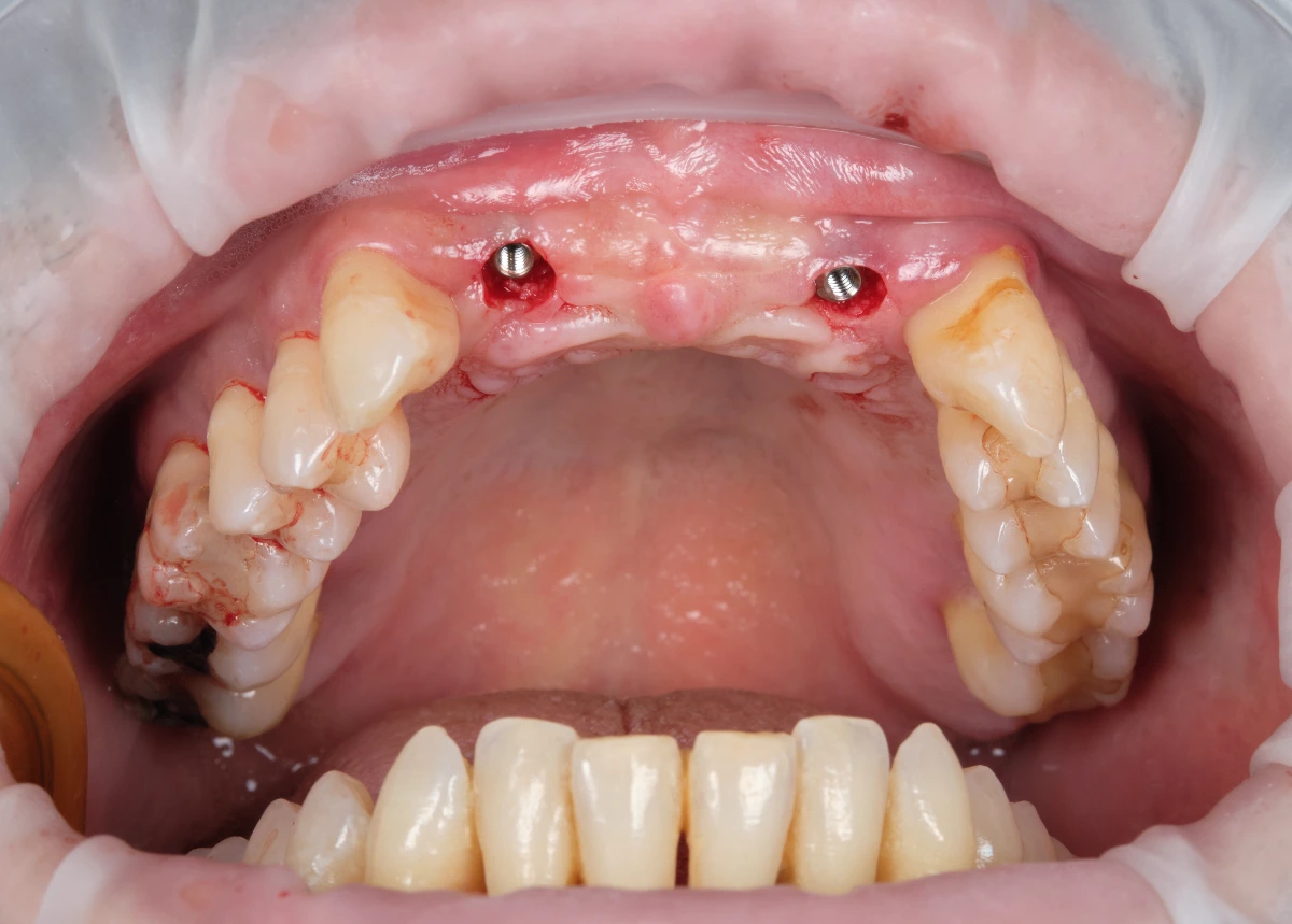 Εμφυτευματα αμέσως μετά την τοποθετηση εμφυτευματα ηρακλειο κρητης