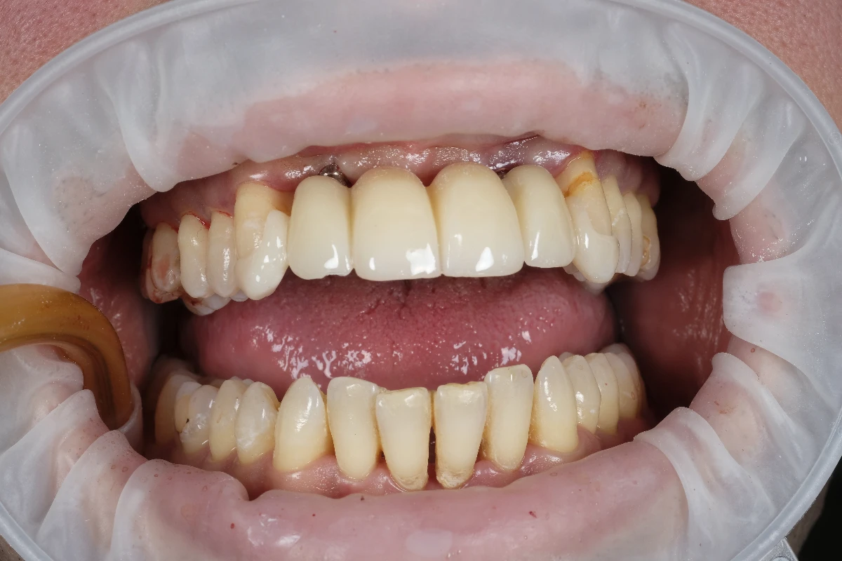 Ομοιόμορφη αποκατάσταση σύμφωνα με τα παρακείμενα δόντια Άμμεση αποκατάσταση πάνω σε εμφυτευματα δοντιών